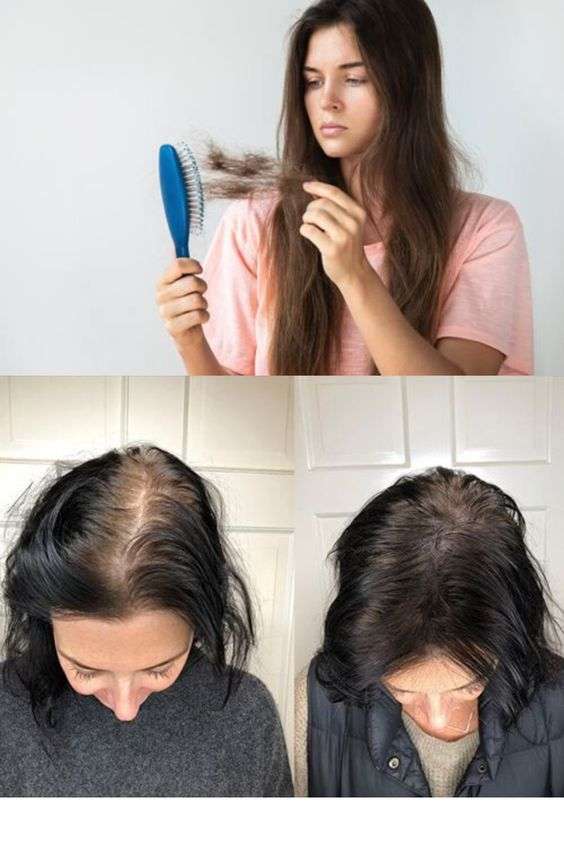 علاج تساقط الشعر 2022 افضل علاج تساقط الشعر للرجال النساء وصفات