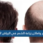 اسعار واماكن زراعة الشعر في الرياض 2022
