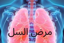 مرض السل(Tuberculosis)؛ أعراضه وأسبابه - شبكة فهرس