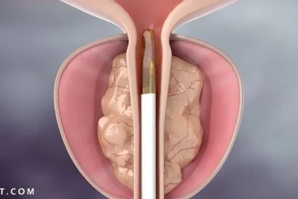 تجربتي مع احتقان البروستاتا - موقع مُحيط