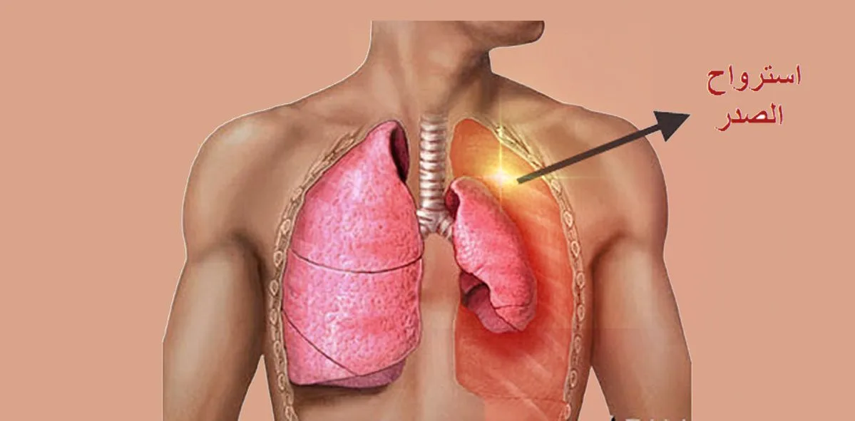 ماهو إسترواح الصدر الأعراض الأسباب وطرق العلاج Pneumothorax