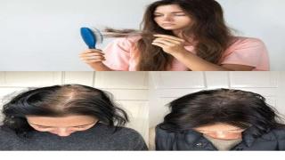 علاج تساقط الشعر 2024 افضل علاج تساقط الشعر للرجال النساء وصفات