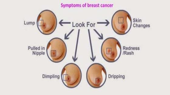 أعراض سرطان الثدي ” توهج الجلد “